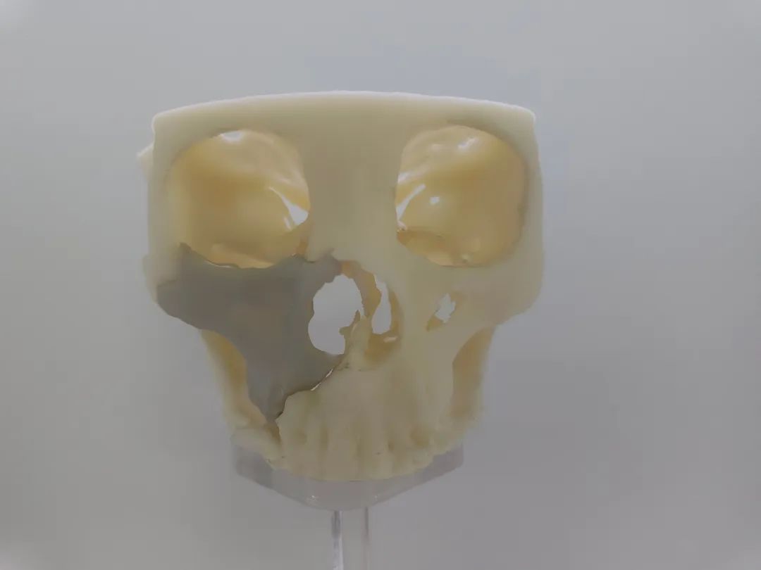 PEEK - Material avanzado para cranioplastia