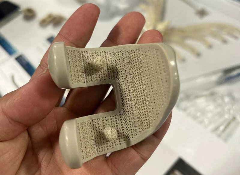 Implantes PEEK de grado médico impresos en 3D