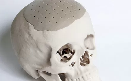 PEEK - Material avanzado para cranioplastia
