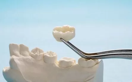 PEEK en implantes dentales: Biocompatibilidad y beneficios estéticos